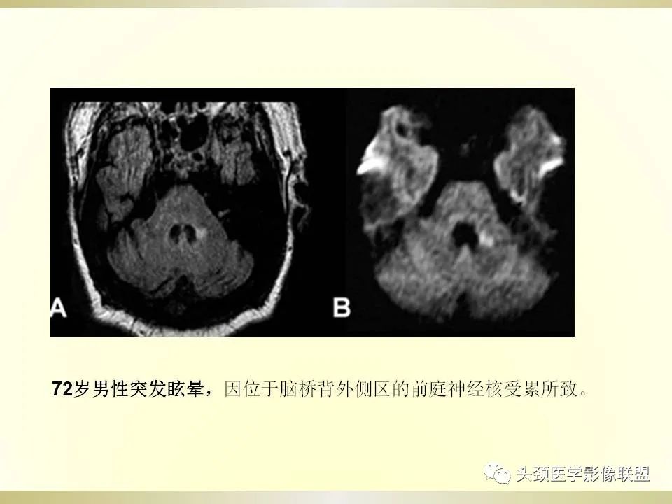 影像PPT - 【PPT】脑桥病变的定性诊断与影像学特点-8