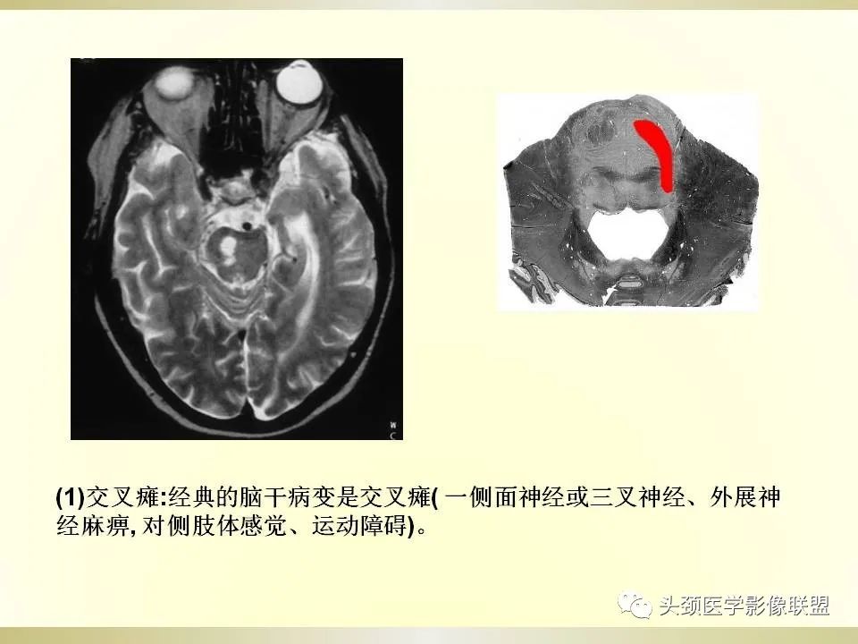 影像PPT - 【PPT】脑桥病变的定性诊断与影像学特点-10