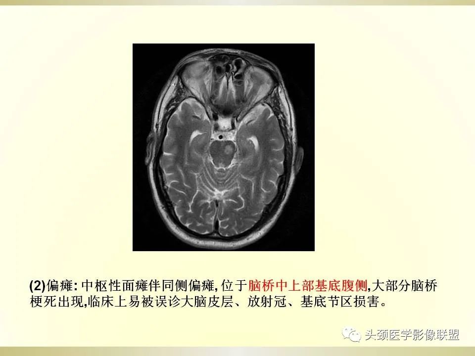 影像PPT - 【PPT】脑桥病变的定性诊断与影像学特点-11