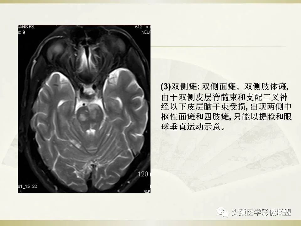 影像PPT - 【PPT】脑桥病变的定性诊断与影像学特点-12