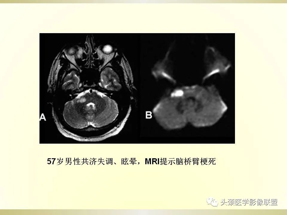 影像PPT - 【PPT】脑桥病变的定性诊断与影像学特点-17