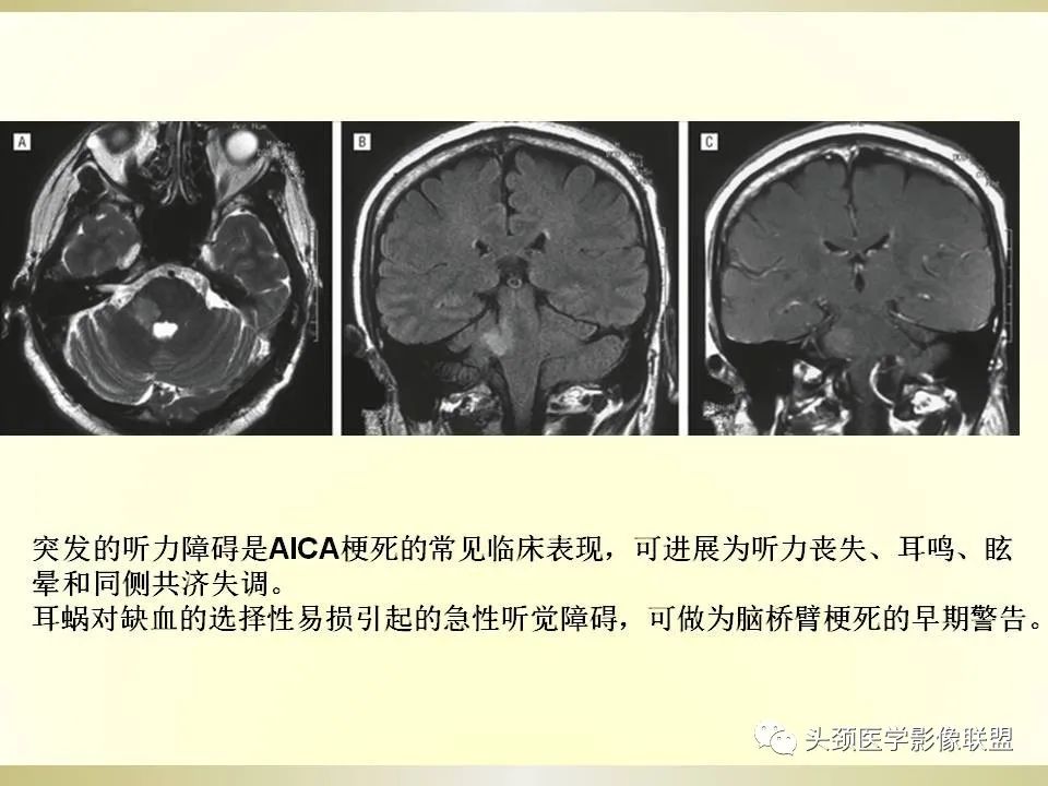 影像PPT - 【PPT】脑桥病变的定性诊断与影像学特点-18