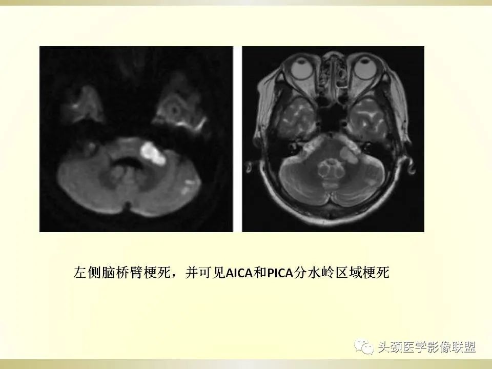 影像PPT - 【PPT】脑桥病变的定性诊断与影像学特点-19