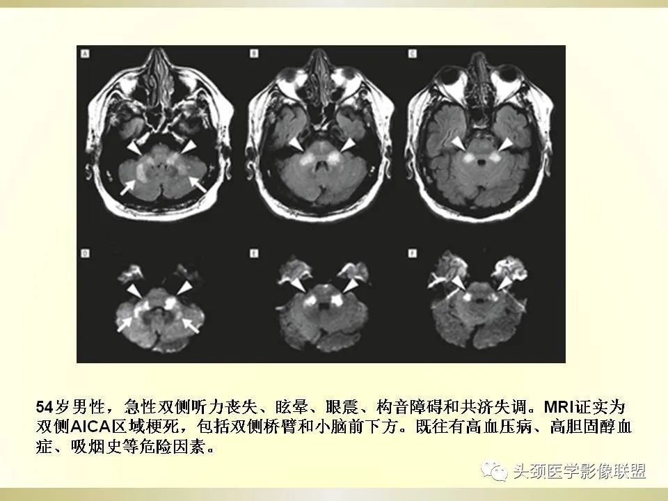 影像PPT - 【PPT】脑桥病变的定性诊断与影像学特点-21
