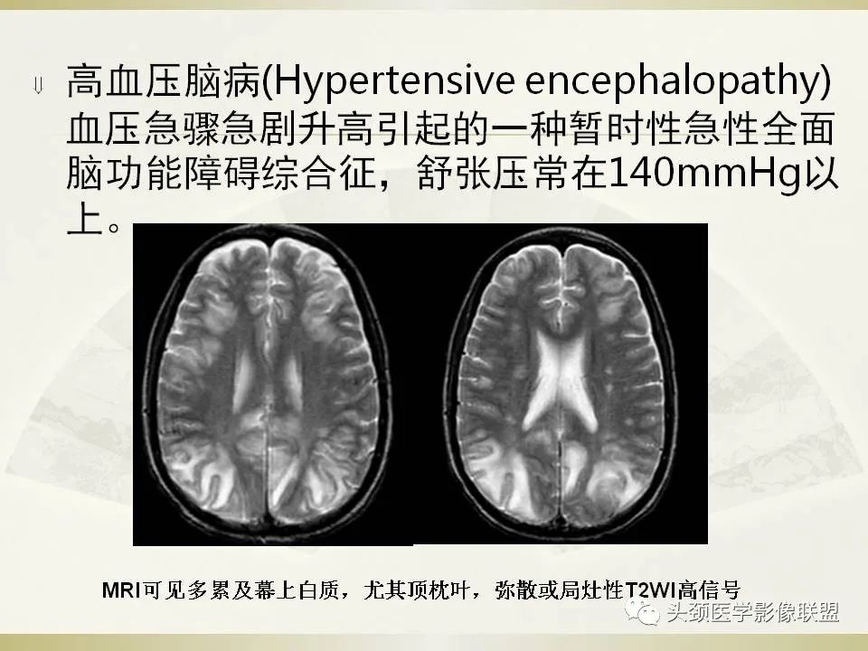 影像PPT - 【PPT】脑桥病变的定性诊断与影像学特点-22