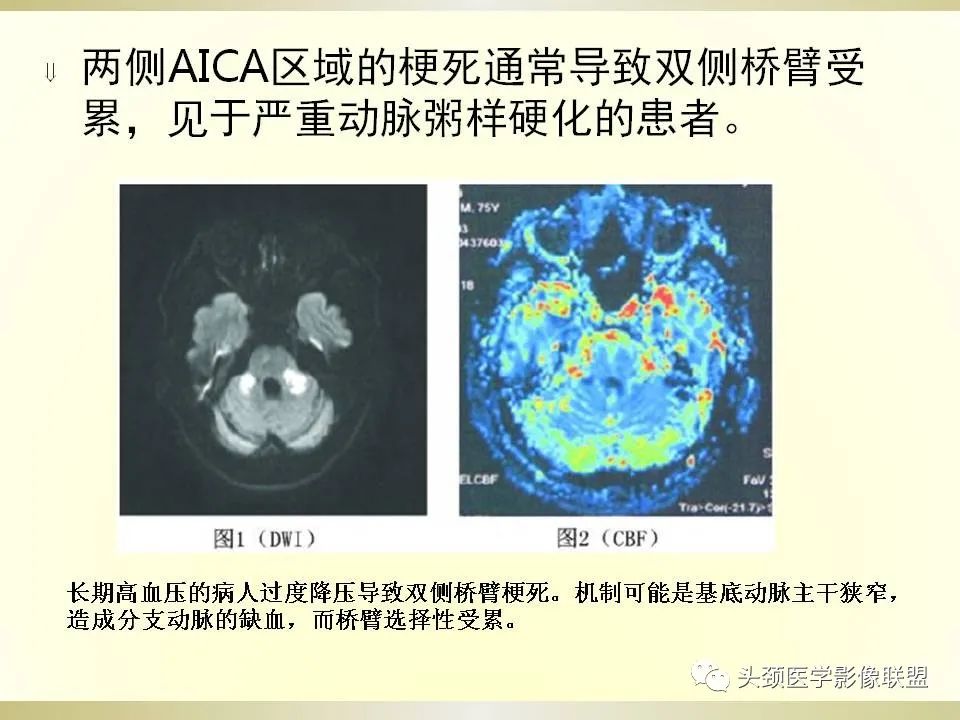 影像PPT - 【PPT】脑桥病变的定性诊断与影像学特点-20