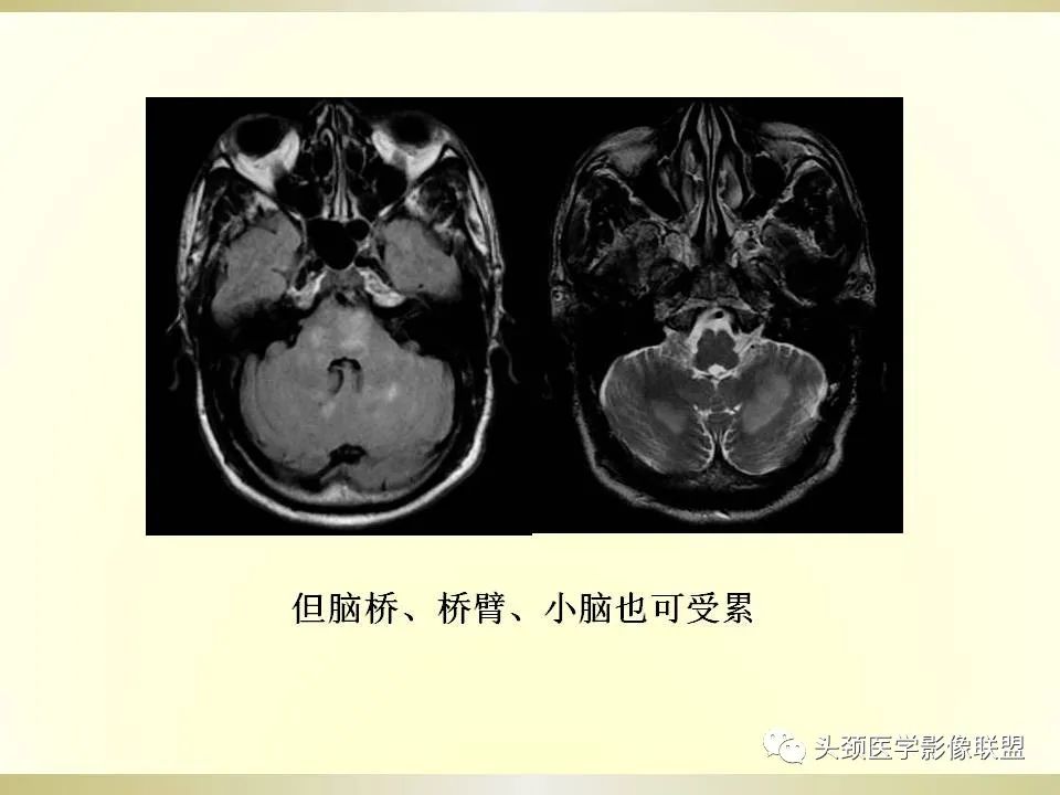 影像PPT - 【PPT】脑桥病变的定性诊断与影像学特点-23
