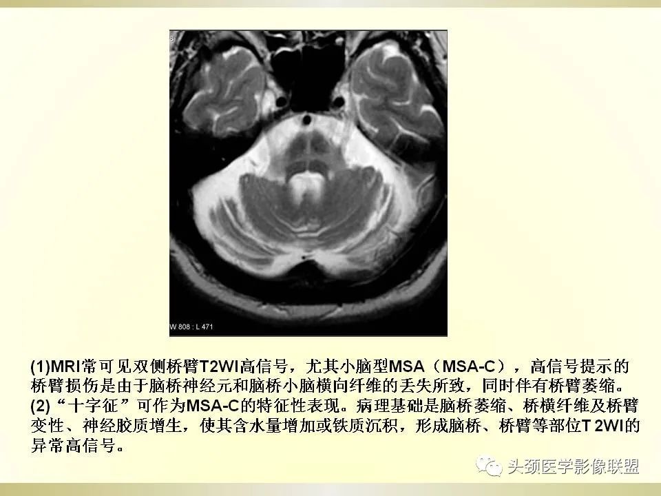 影像PPT - 【PPT】脑桥病变的定性诊断与影像学特点-26