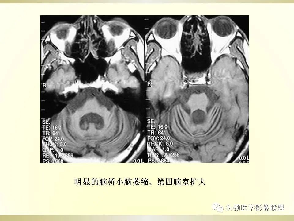 影像PPT - 【PPT】脑桥病变的定性诊断与影像学特点-27