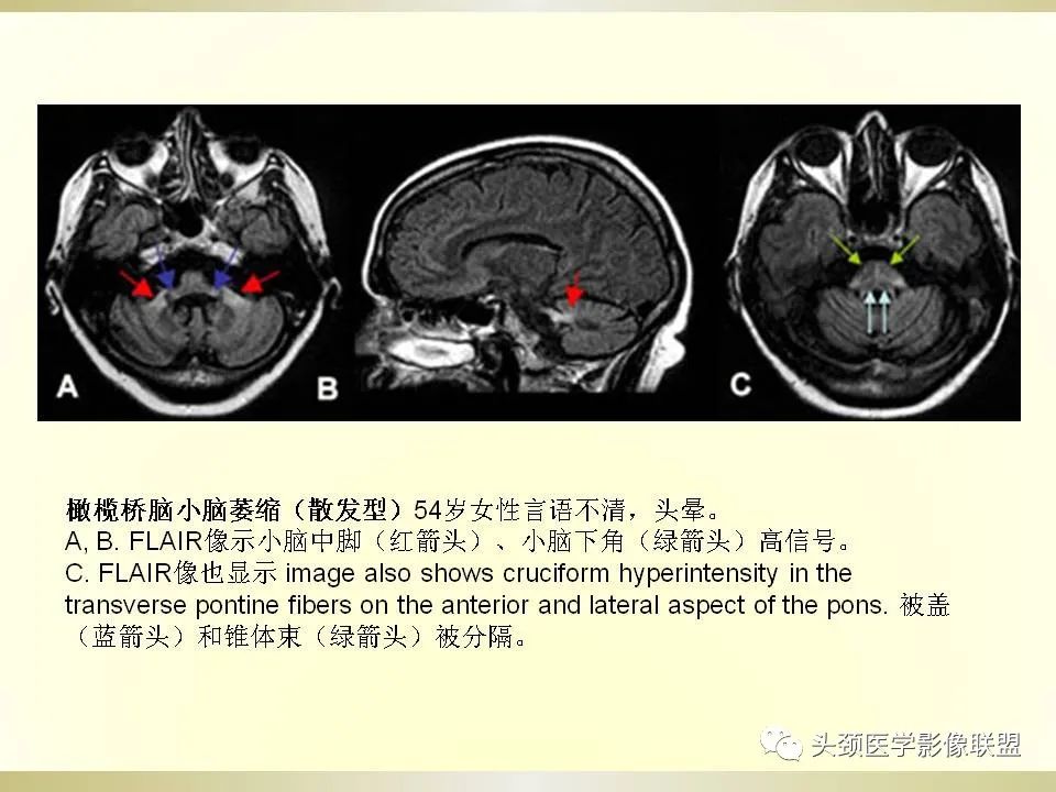 影像PPT - 【PPT】脑桥病变的定性诊断与影像学特点-28
