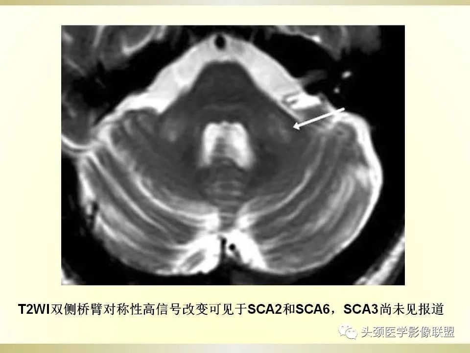 影像PPT - 【PPT】脑桥病变的定性诊断与影像学特点-30