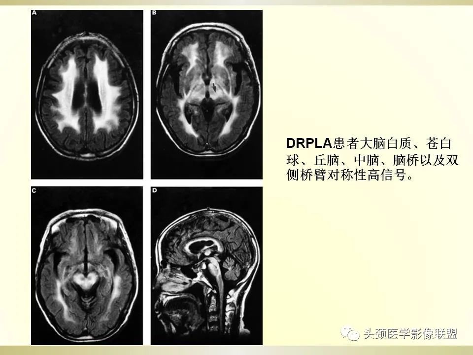 影像PPT - 【PPT】脑桥病变的定性诊断与影像学特点-32