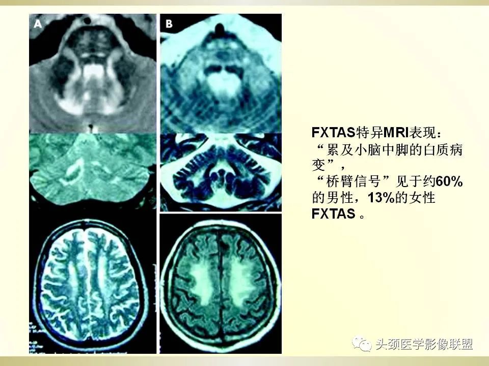 影像PPT - 【PPT】脑桥病变的定性诊断与影像学特点-35