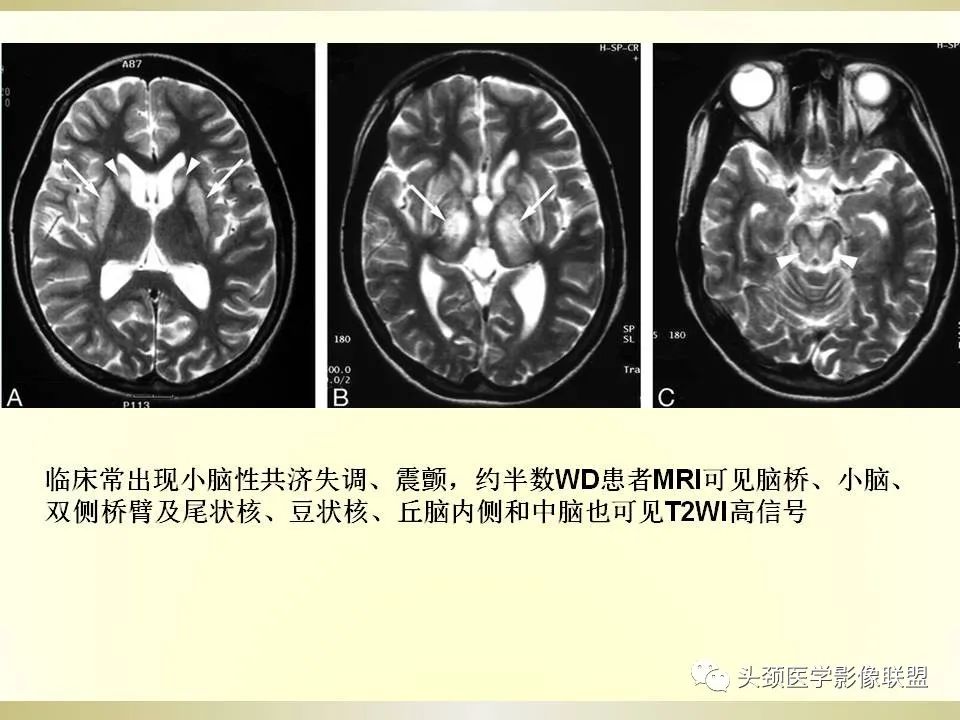 影像PPT - 【PPT】脑桥病变的定性诊断与影像学特点-37
