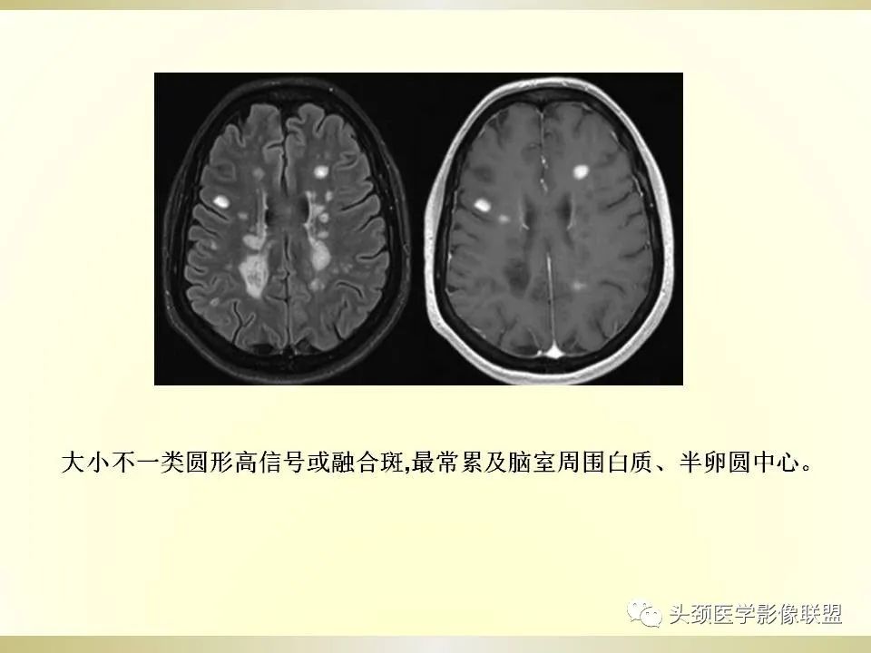 影像PPT - 【PPT】脑桥病变的定性诊断与影像学特点-40