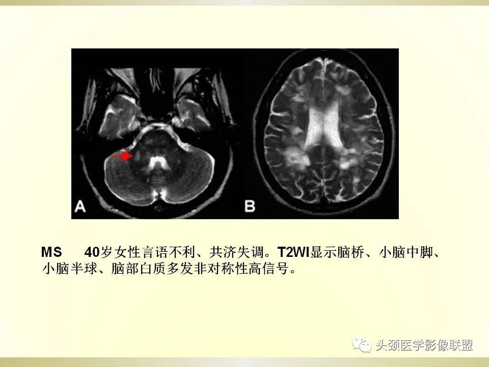 影像PPT - 【PPT】脑桥病变的定性诊断与影像学特点-41