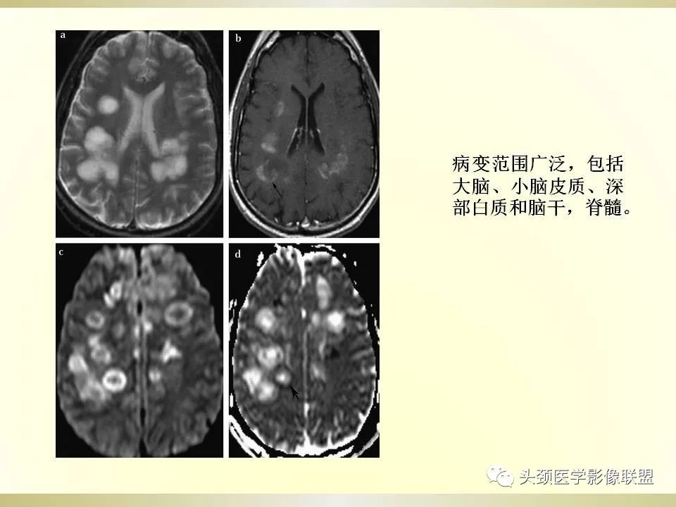影像PPT - 【PPT】脑桥病变的定性诊断与影像学特点-43