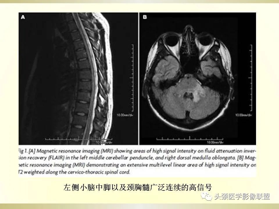影像PPT - 【PPT】脑桥病变的定性诊断与影像学特点-44