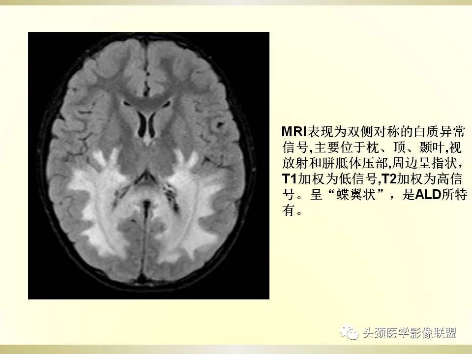 影像PPT - 【PPT】脑桥病变的定性诊断与影像学特点-46