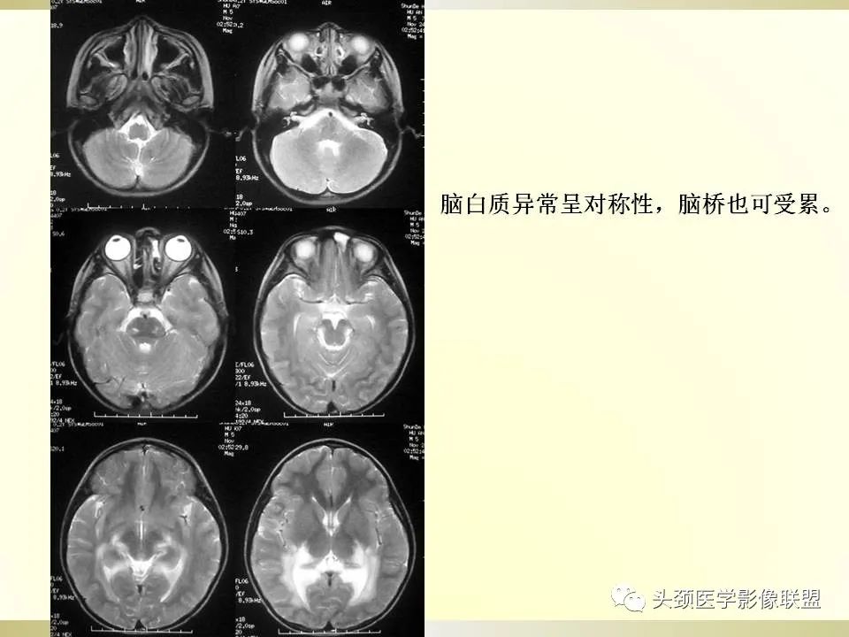 影像PPT - 【PPT】脑桥病变的定性诊断与影像学特点-47