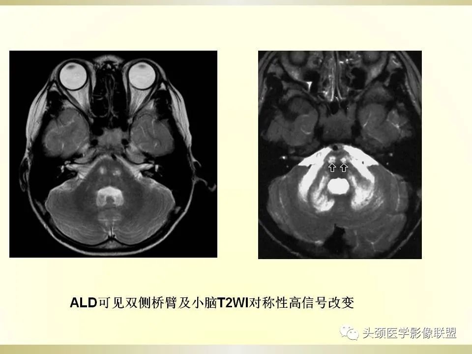 影像PPT - 【PPT】脑桥病变的定性诊断与影像学特点-48