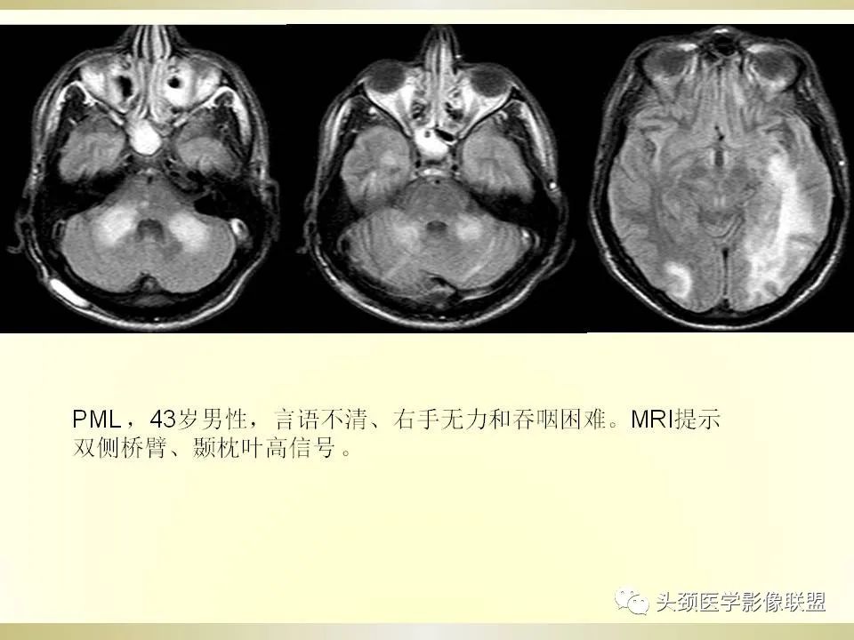 影像PPT - 【PPT】脑桥病变的定性诊断与影像学特点-50