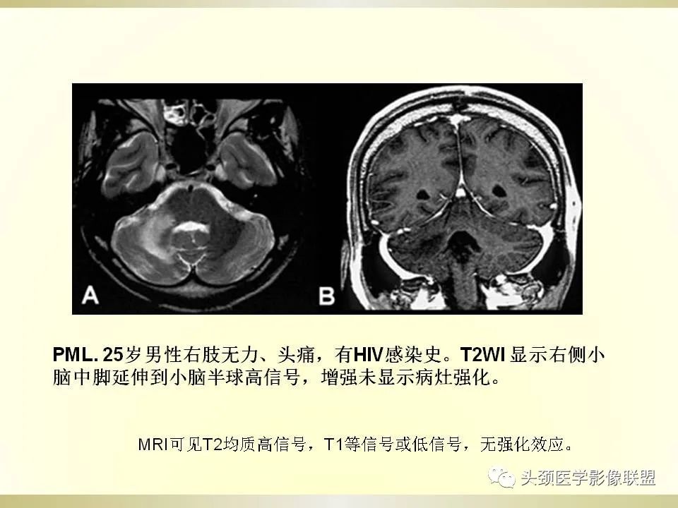 影像PPT - 【PPT】脑桥病变的定性诊断与影像学特点-51