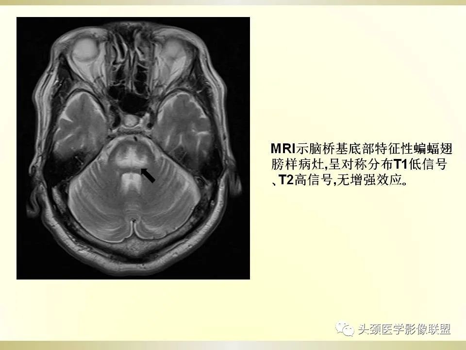 影像PPT - 【PPT】脑桥病变的定性诊断与影像学特点-53