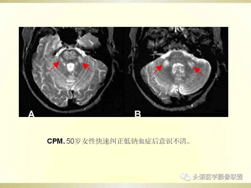 影像PPT - 【PPT】脑桥病变的定性诊断与影像学特点-54