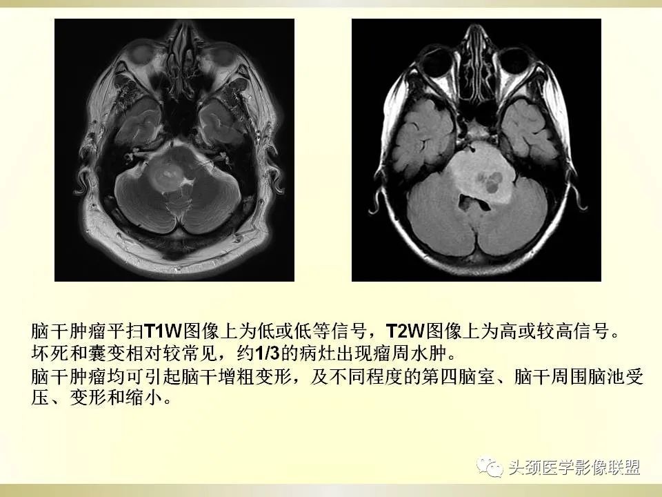 影像PPT - 【PPT】脑桥病变的定性诊断与影像学特点-56