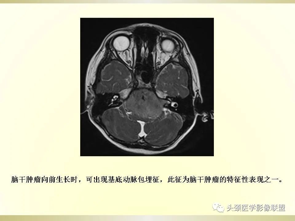 影像PPT - 【PPT】脑桥病变的定性诊断与影像学特点-57