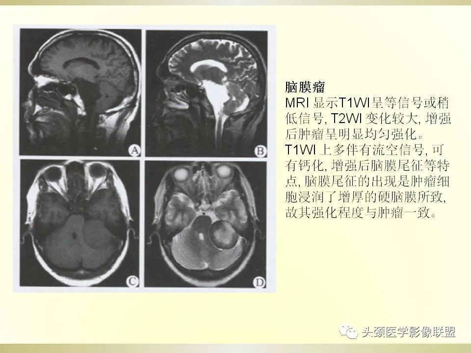 影像PPT - 【PPT】脑桥病变的定性诊断与影像学特点-59