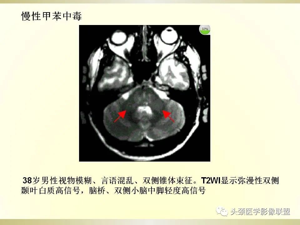 影像PPT - 【PPT】脑桥病变的定性诊断与影像学特点-61