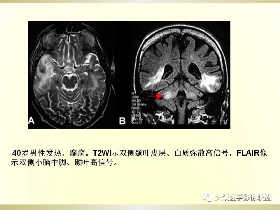 影像PPT - 【PPT】脑桥病变的定性诊断与影像学特点-63