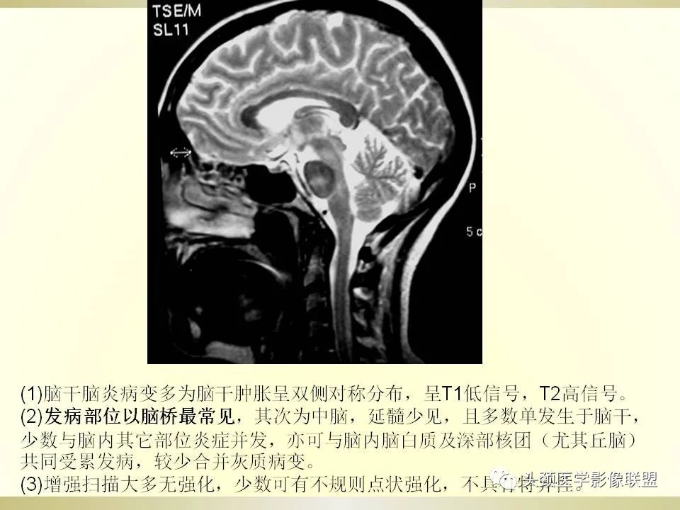影像PPT - 【PPT】脑桥病变的定性诊断与影像学特点-65