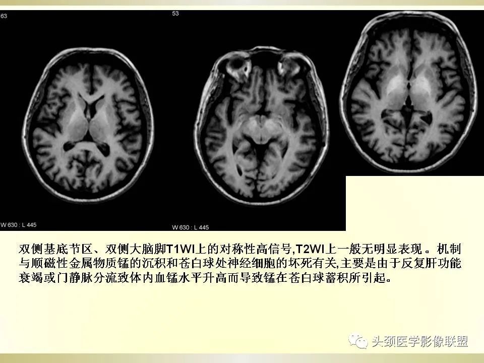 影像PPT - 【PPT】脑桥病变的定性诊断与影像学特点-67