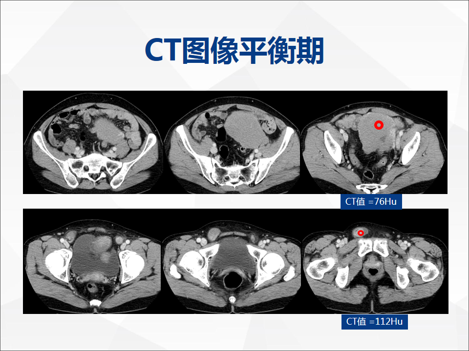 影像PPT - 【病例】睾丸精原细胞瘤1例CT及MR-6