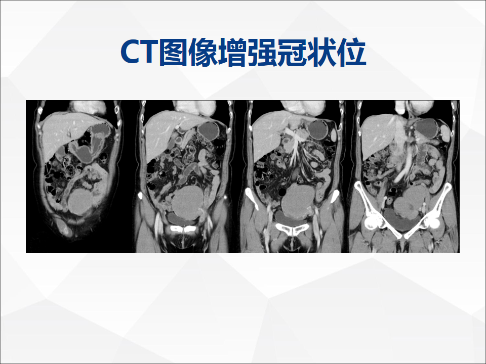 影像PPT - 【病例】睾丸精原细胞瘤1例CT及MR-7