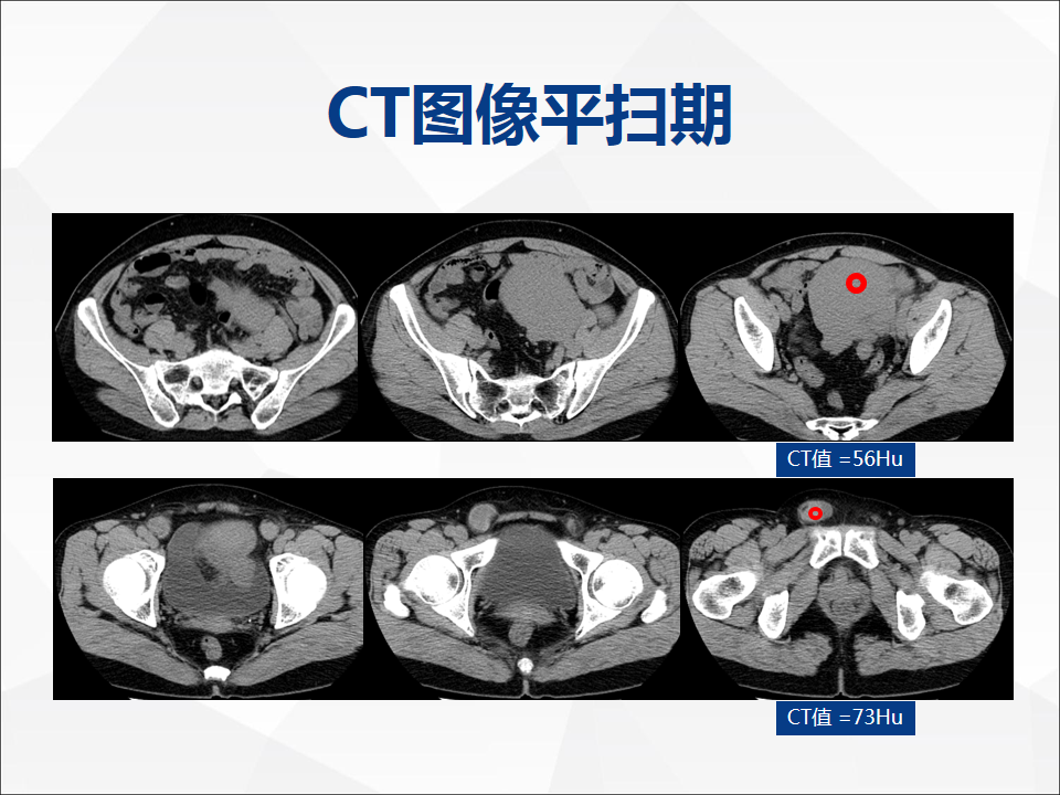 影像PPT - 【病例】睾丸精原细胞瘤1例CT及MR-4