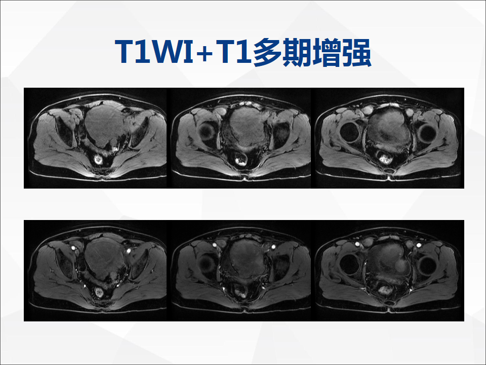 影像PPT - 【病例】睾丸精原细胞瘤1例CT及MR-9