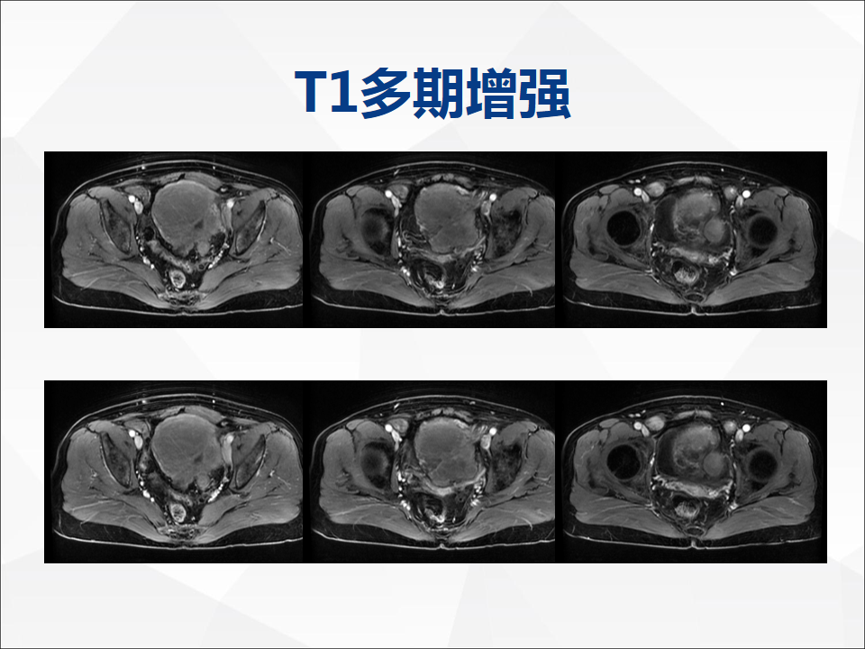 影像PPT - 【病例】睾丸精原细胞瘤1例CT及MR-10
