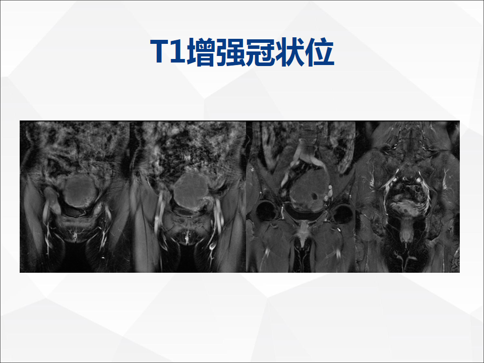 影像PPT - 【病例】睾丸精原细胞瘤1例CT及MR-11