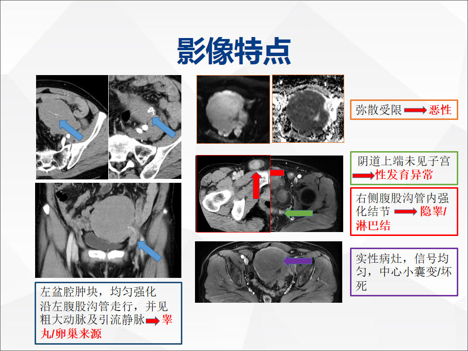 影像PPT - 【病例】睾丸精原细胞瘤1例CT及MR-18