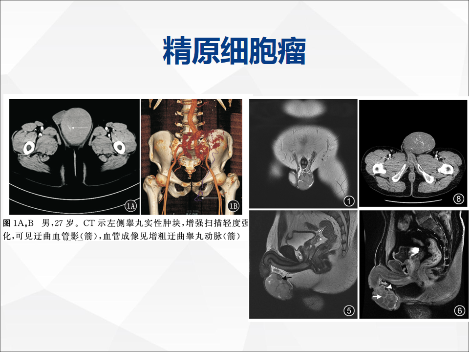影像PPT - 【病例】睾丸精原细胞瘤1例CT及MR-21