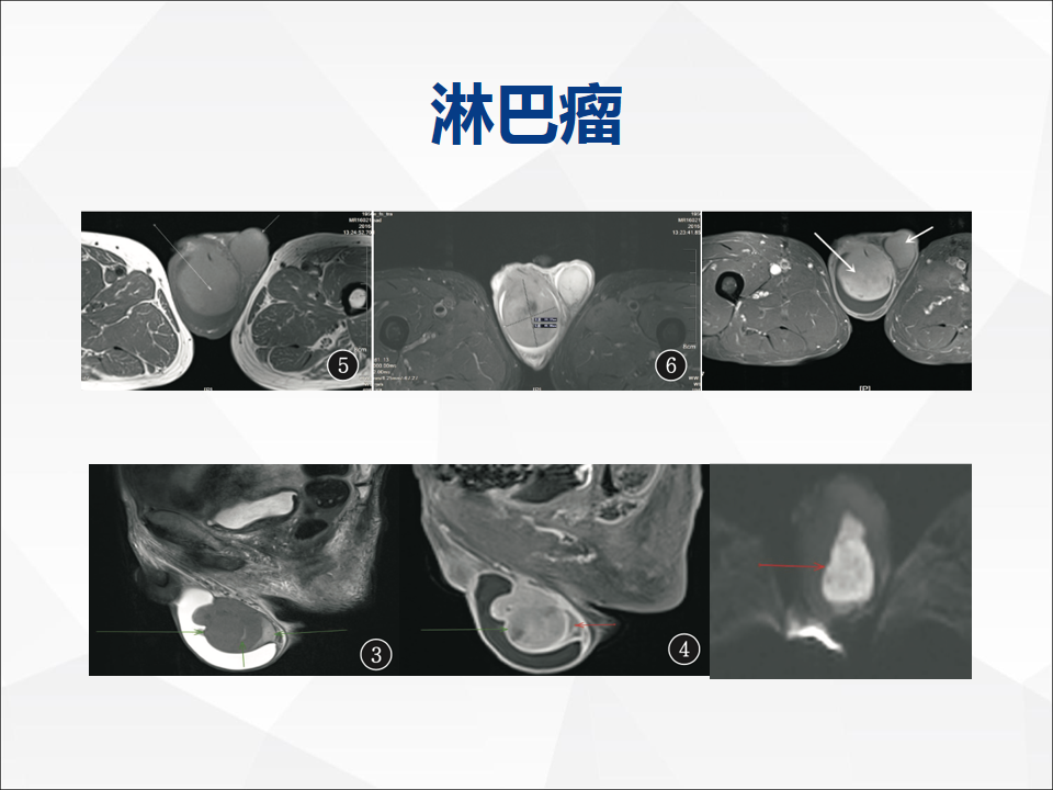 影像PPT - 【病例】睾丸精原细胞瘤1例CT及MR-27