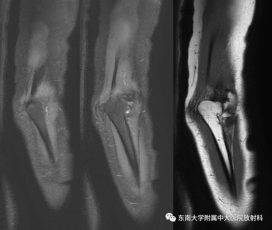影像PPT - 【PPT】肘管综合征-3