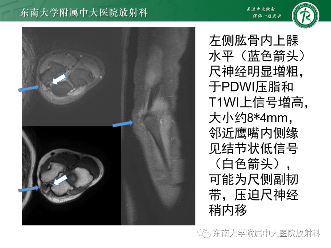 影像PPT - 【PPT】肘管综合征-4