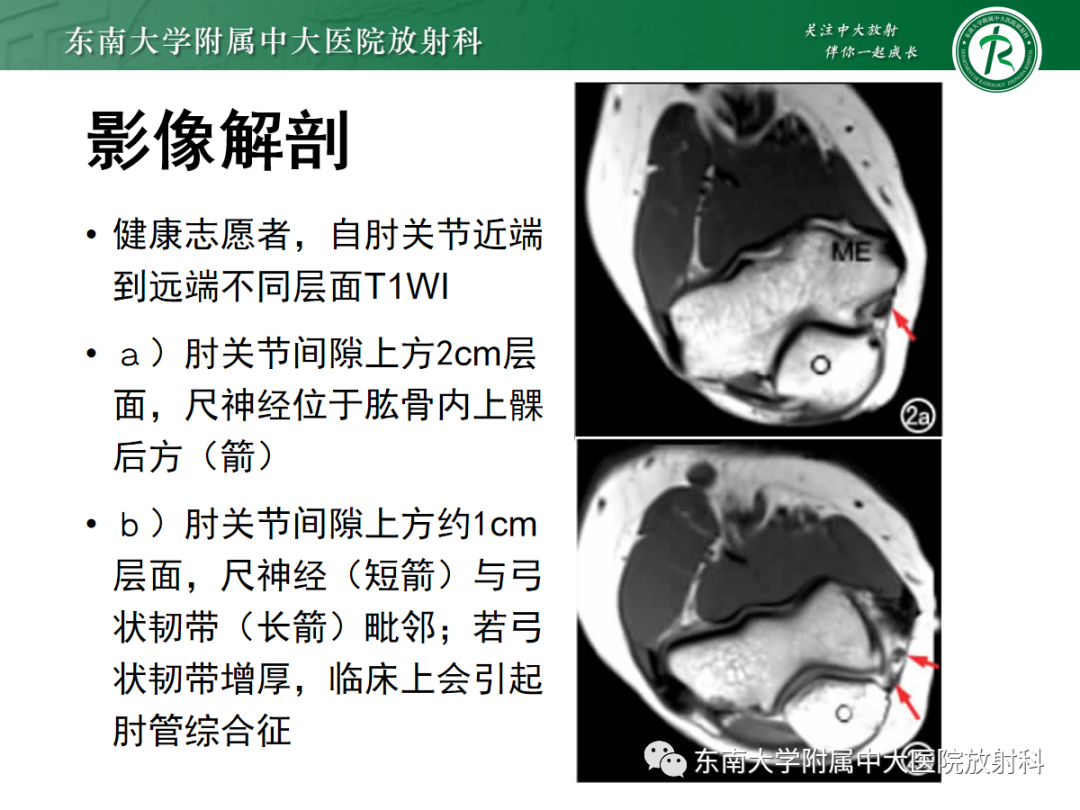 影像PPT - 【PPT】肘管综合征-14