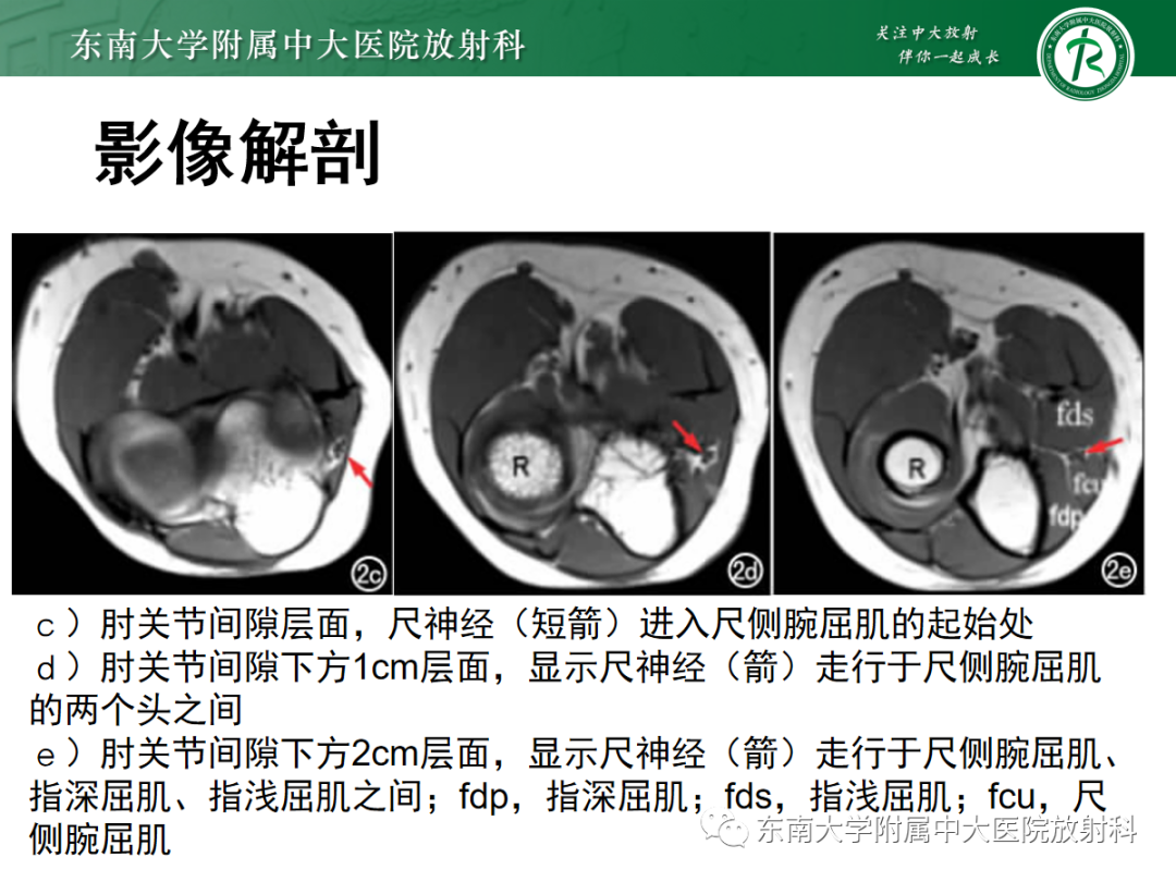 影像PPT - 【PPT】肘管综合征-15