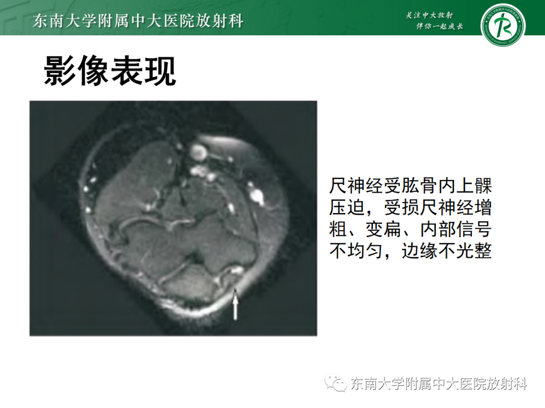 影像PPT - 【PPT】肘管综合征-22